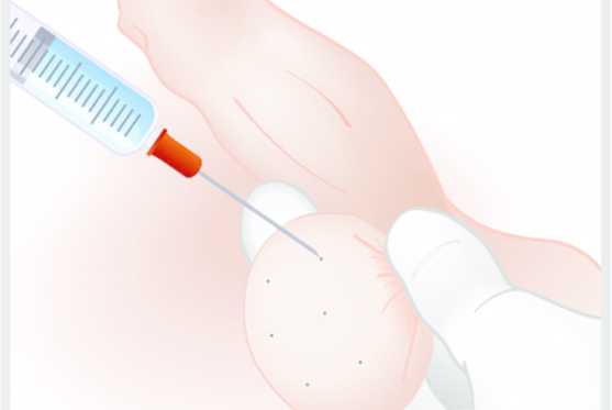 Fine Needle Aspiration (FNA)