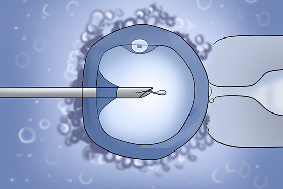 ICSI Treatment