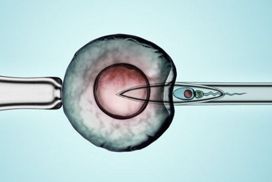 Intra-Cytoplasmic Morphologically-Selected Sperm Injection (IMSI)