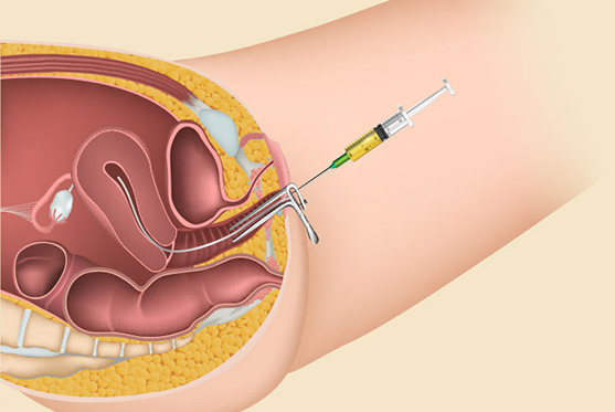 Intrauterine Insemination - IUI Treatment
