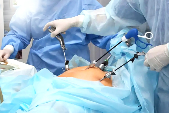 Laparoscopy Surgery