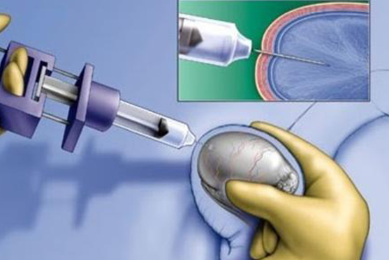 Micro Epididymal Sperm Aspiration (MESA)