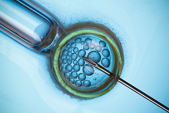 Microsurgical Testicular Sperm Extraction (Micro TESE)