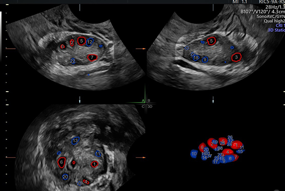 Ovarian Reserve Testing