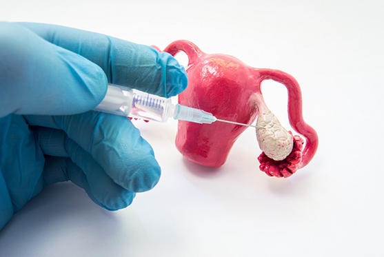 Ovulation Induction