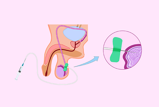 Percutaneous Epididymal Sperm Aspiration (PESA)