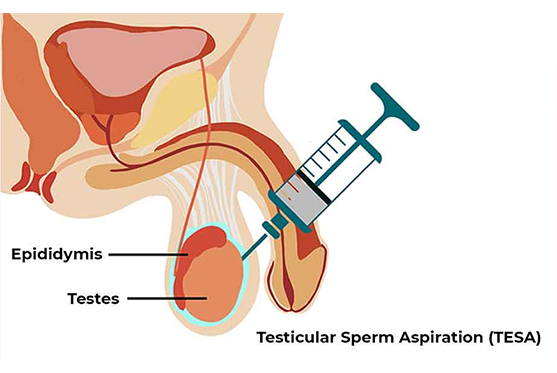 Testicular Sperm Aspiration (TESA)
